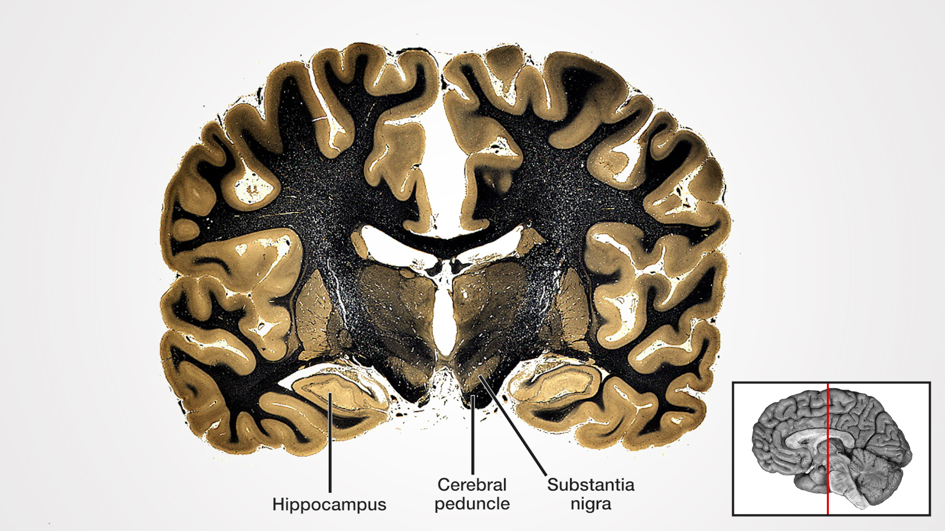 Labels (left to right): Hippocampus, cerebral peduncle, substantia nigra